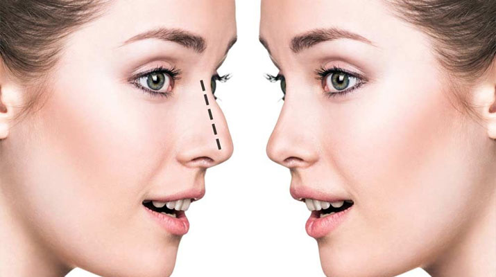 Top 15 Best Rhinoplasty (Nose Job) Doctors In Turkey – World