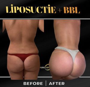 fotos voor en na bbl braziliaanse butt lift operatie