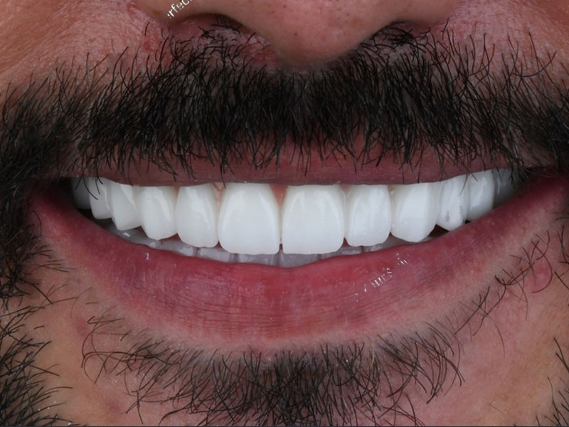 tips voor vergeelde en verkleurde tanden