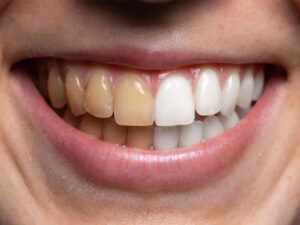 tips voor vergeelde en verkleurde tanden