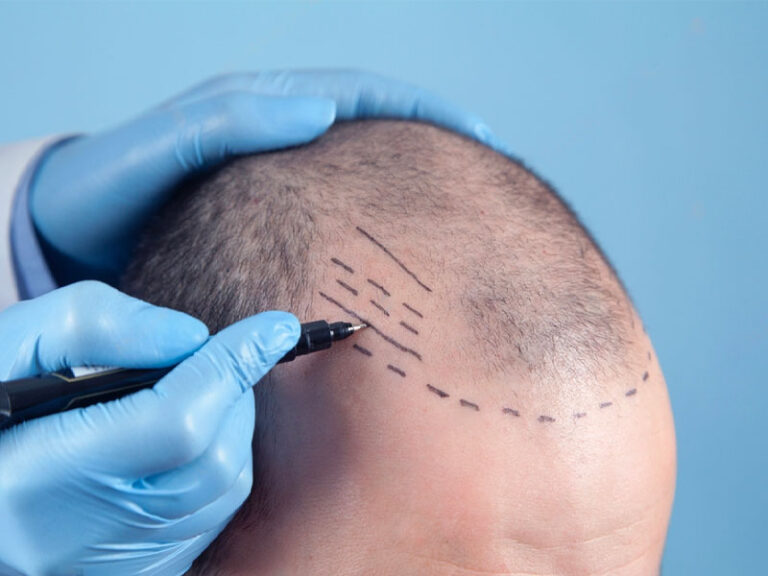 s breakthroughs in hair transplantation new horizons in hair restoration