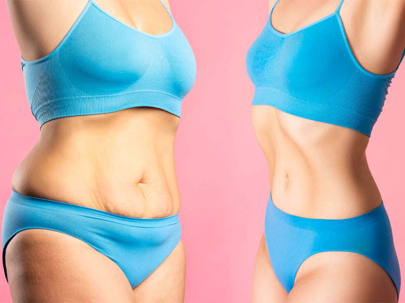 What Type Of Tummy Tuck Is Best For You? 2024