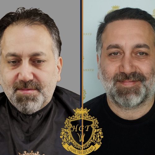 hair transplant before and after photos in turkey