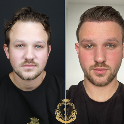 hair transplant before and after photos in turkey