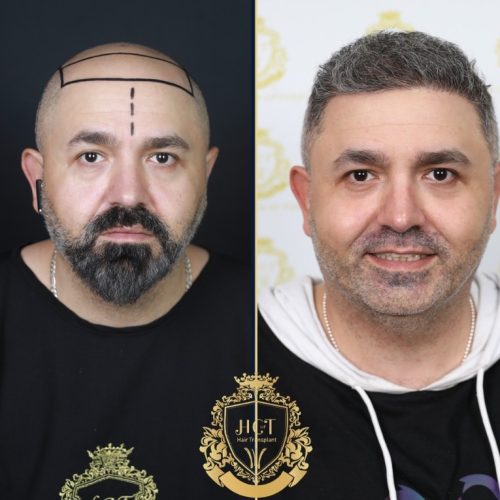 hair transplant before and after photos in turkey