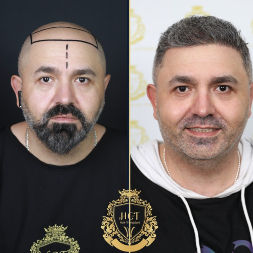 hair transplant before and after photos in turkey