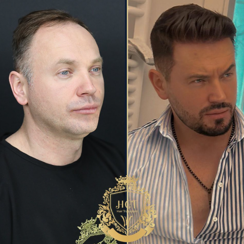 hair transplant before and after photos in turkey