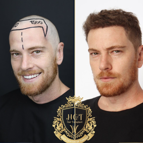 hair transplant before and after photos in turkey