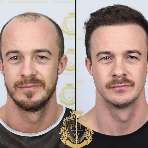 hair transplant before and after photos in turkey