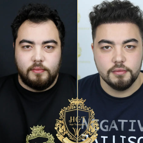 hair transplant before and after photos in turkey