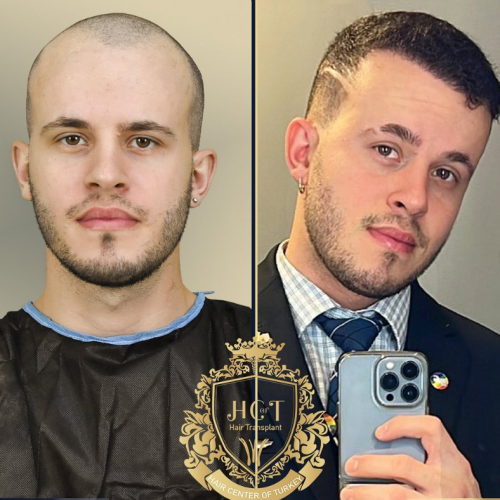 hair transplant before and after photos in turkey