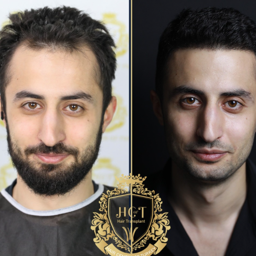 hair transplant before and after photos in turkey