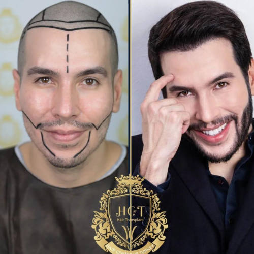 hair transplant before and after photos in turkey