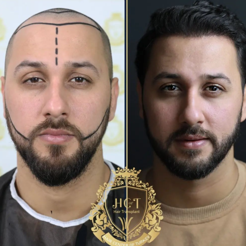 hair transplant before and after photos in turkey