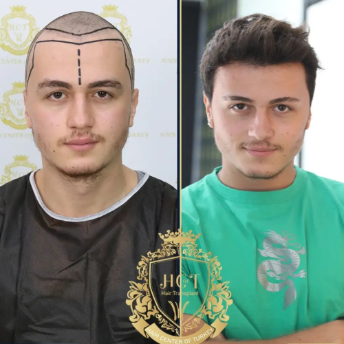 hair transplant before and after photos in turkey