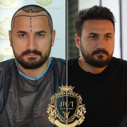 hair transplant before and after photos in turkey