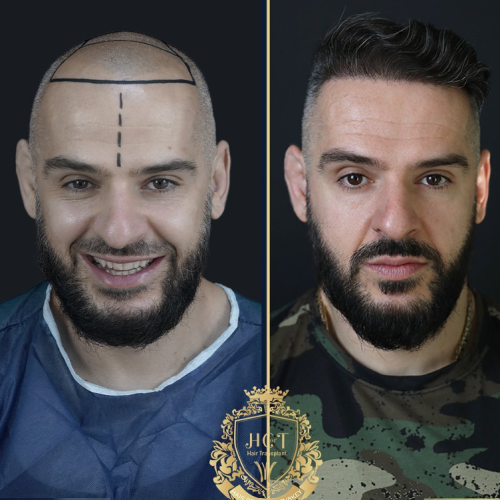 hair transplant before and after photos in turkey