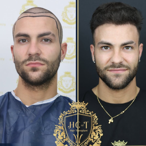 hair transplant before and after photos in turkey