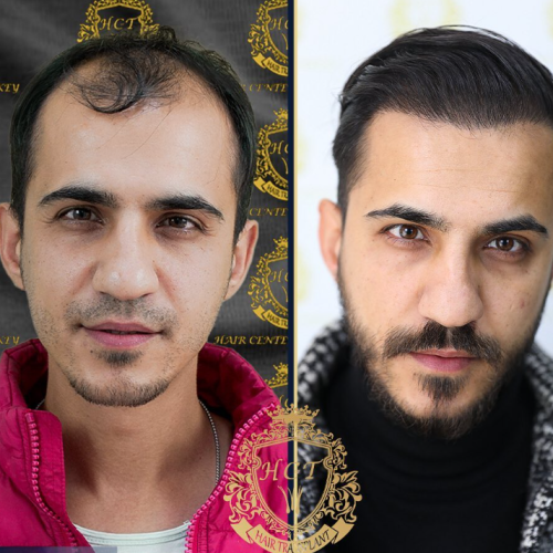 hair transplant before and after photos in turkey