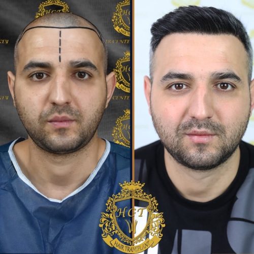 hair transplant before and after photos in turkey