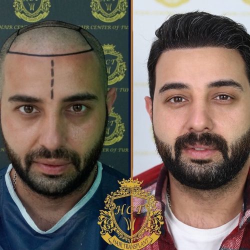 hair transplant before and after photos in turkey