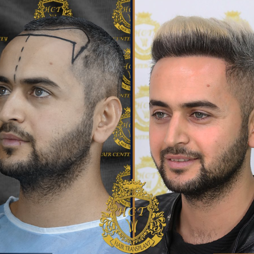 hair transplant before and after photos in turkey