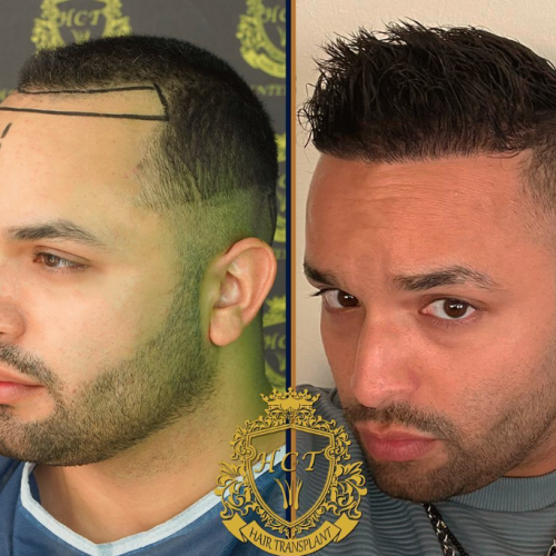 hair transplant before and after photos in turkey