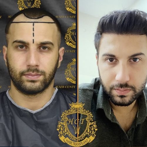 hair transplant before and after photos in turkey