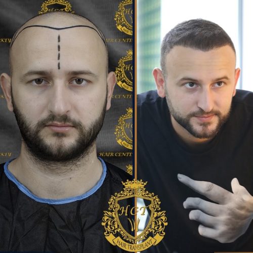 hair transplant before and after photos in turkey