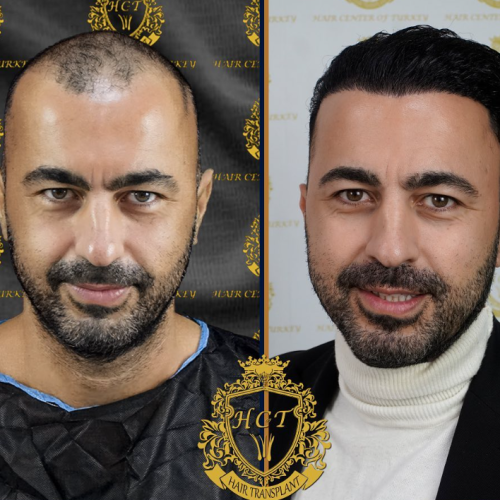 hair transplant before and after photos in turkey