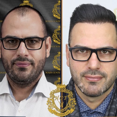 hair transplant before and after photos in turkey