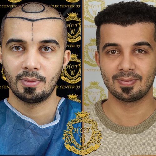 hair transplant before and after photos in turkey