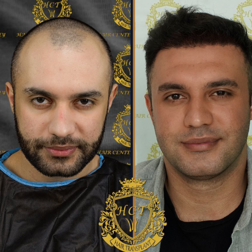 hair transplant before and after photos in turkey