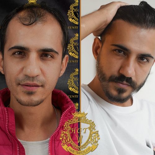 hair transplant before and after photos in turkey