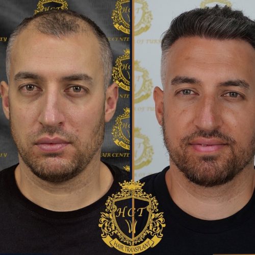 hair transplant before and after photos in turkey