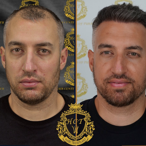 hair transplant before and after photos in turkey