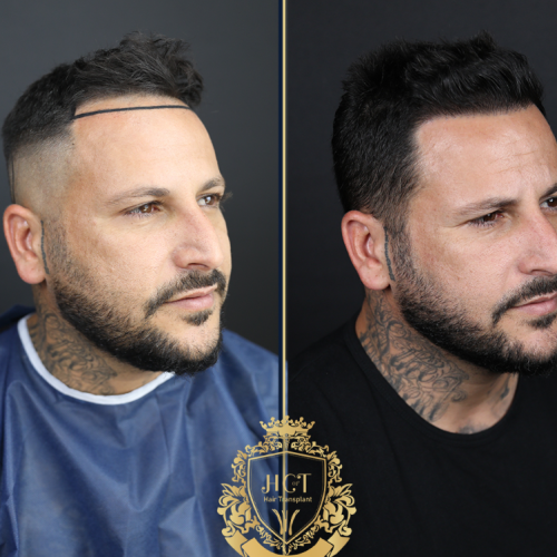 hair transplant before and after photos in turkey