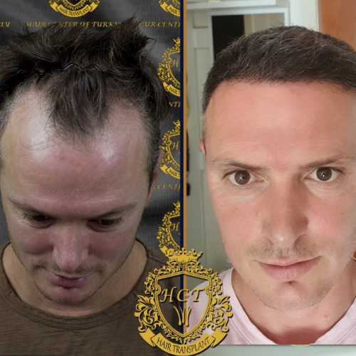 hair transplant before and after photos in turkey