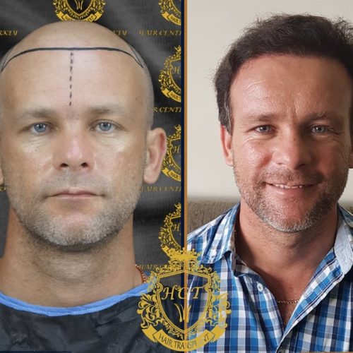 hair transplant before and after photos in turkey