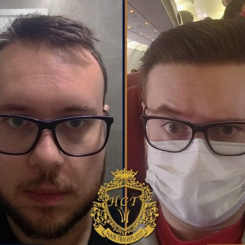 hair transplant before and after photos in turkey