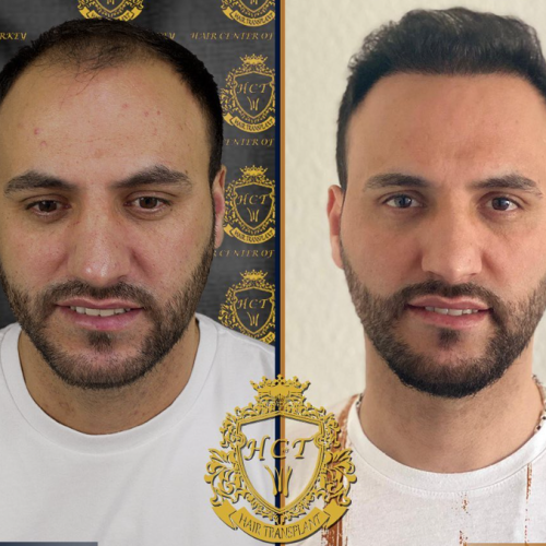 hair transplant before and after photos in turkey