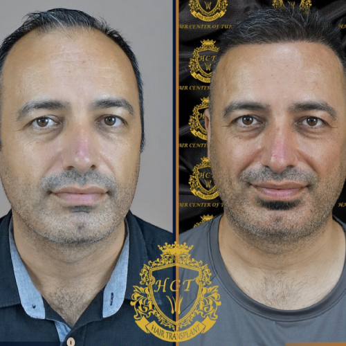 hair transplant before and after photos in turkey