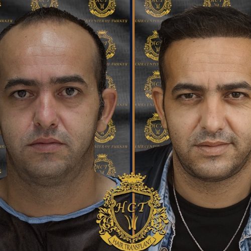 hair transplant before and after photos in turkey