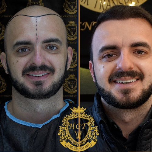 hair transplant before and after photos in turkey