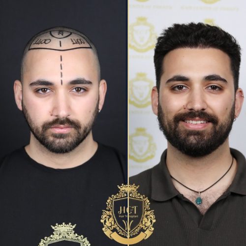 hair transplant before and after photos in turkey