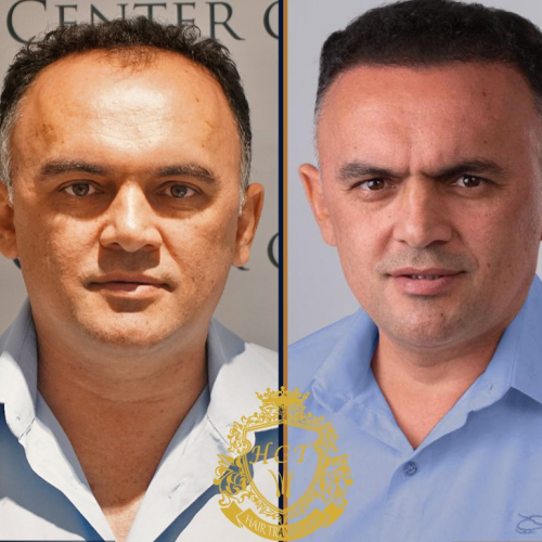 hair transplant before and after photos in turkey