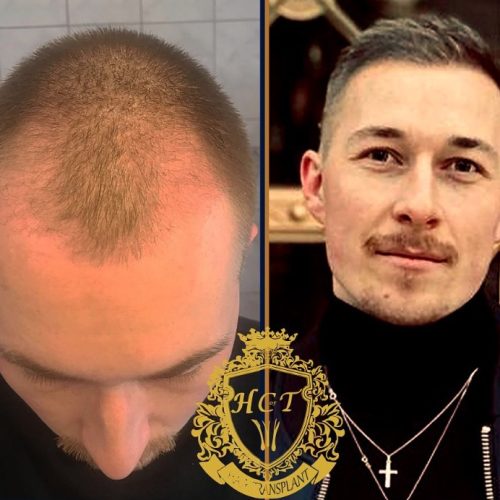 hair transplant before and after photos in turkey