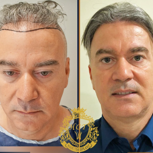 hair transplant before and after photos in turkey