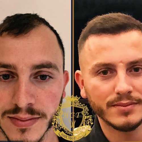 hair transplant before and after photos in turkey