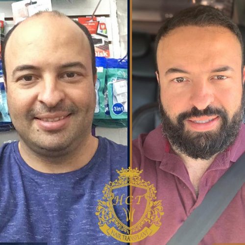 hair transplant before and after photos in turkey